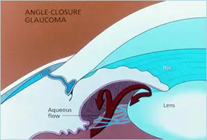 Narrow Angle Glaucoma