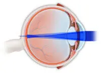 Astigmatism - Vision disorder