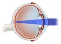 Hyperopia - Vision Problem