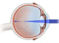 Myopia - Common Vision Problem