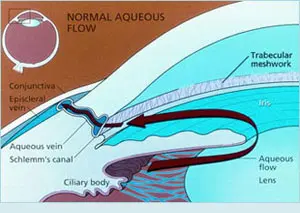 Low Tension Glaucoma