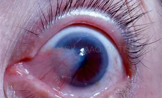 Orange County Pterygium Treatment